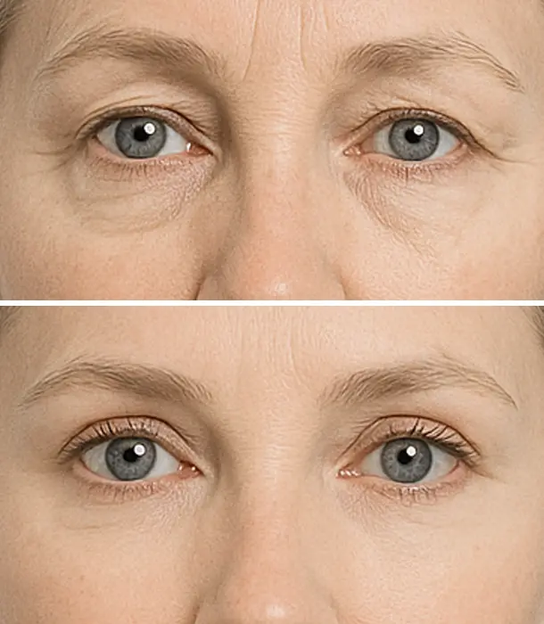 blefaroplastia